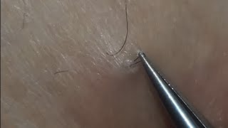 Ingrown hair extraction [upl. by Croom]