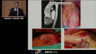 Bicuspid Valve Aortopathy Surgical and Medical Considerations Michael J Reardon MD [upl. by Ardnuhsor]