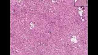 Histopathology LiverViral hepatitis [upl. by Kiah]