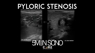 5 Minute Sono  Pyloric Stenosis [upl. by Aenea74]