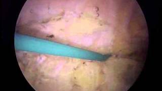 Arthroscopic Lateral Release and Medial Imbrication  ORV  Michael Magoline MD [upl. by Agate711]