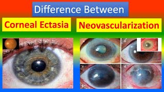 Difference Between Corneal Ectasia and Neovascularization [upl. by Josee64]