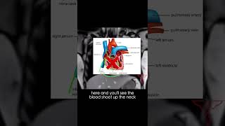 Kussmaul sign explained in less than 1 minute cardiology [upl. by Salohci475]