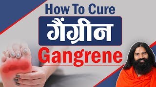 How To Cure Gangrene गैंग्रीन  Swami Ramdev [upl. by Rosario]