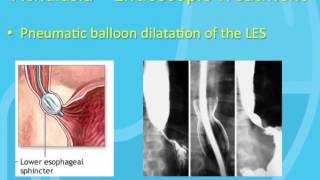 Treatment of Achalasia [upl. by Fae]