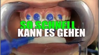 SO SCHNELL wird die FESTE ZAHNSPANGE eingesetzt  Orthodentix [upl. by Yenahs]