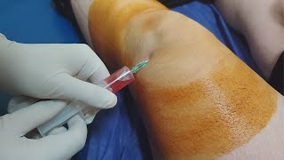 Knee fluid removal  Arthrocentesis  Synovial fluid aspiration procedure [upl. by Kcirddehs]