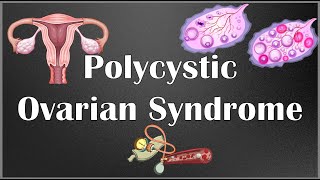 Polycystic Ovarian Syndrome PCOS  Causes Signs amp Symptoms Diagnosis amp Treatment [upl. by Oilla708]