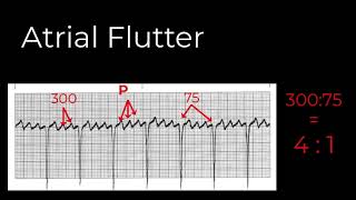 7 Atrial Rhythms [upl. by Enavi]