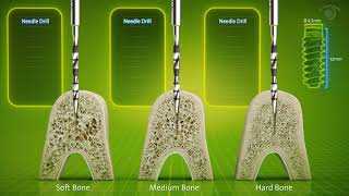 Straumann® BLX Drilling Protocol [upl. by Carisa209]