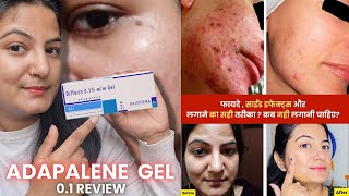 How to Use Adapalene Gel 01  Full Detail Video  Best Gel For Removing Blackheads and Pimples [upl. by Mattson]