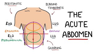 Acute Abdomen  A Guide to Acute Abdominal Pain [upl. by Atelokin]