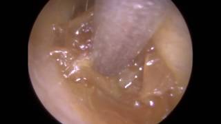 258  Soft Impacted and Occluding Ear Wax Removal off Eardrum Mr Neel Raithatha [upl. by Alyal]