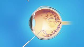 Macular Pucker Vitrectomy Surgery [upl. by Esya]