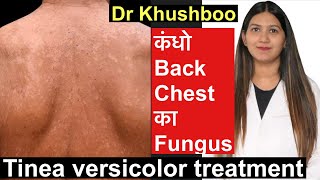 Tinea Versicolor Treatment  सेहुआ करोडियासीप Tinea body fungus treatment [upl. by Derman]