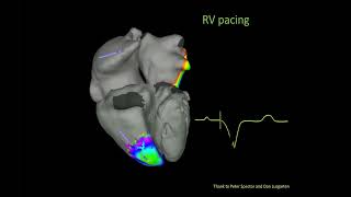 Bradycardia amp Pacing  Cardiology Board Review [upl. by Akeem]