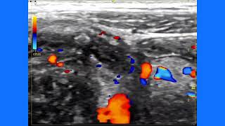 Acute appendicitis ultrasound and color Doppler video [upl. by Aplihs]