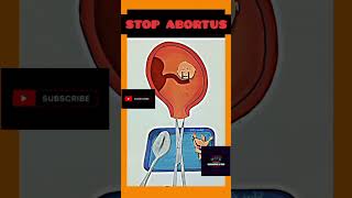 Stop Abortus 💔 foryou shortvideo viralvideo [upl. by Stratton]