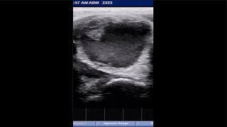 THYROID CYST ultrasound hormones thyroid [upl. by Ecinna930]