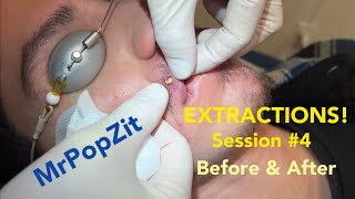 Severe Acne extractions Session 4 amazing before and after So many pops [upl. by Oren]