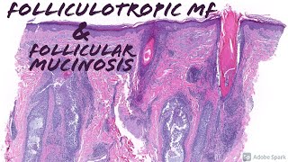 Folliculotropic Mycosis Fungoides Cutaneous Tcell Lymphoma amp Follicular Mucinosis [upl. by Jacquenette]