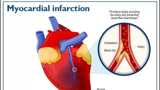 Myocardial infarction STEMIINFERIOR WALL MI amp LATERAL WALL MIECG [upl. by Teressa339]