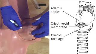 Emergency Needle Cricothyrotomy Procedure Explained [upl. by Naerol854]