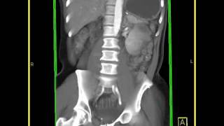 Abdomen Small Bowel Carcinoid tumor of the small bowel VRT images [upl. by Evangelist]