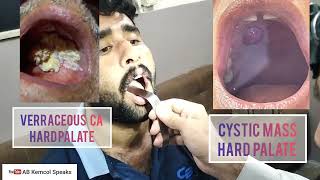 Examination of Oral Cavity  Mouth Examination  ENT Examination Part 03 [upl. by Eilime]