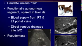 Sonography of the Liver [upl. by Thorne151]