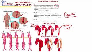 Aneurisma de Aorta [upl. by Enneyehs]