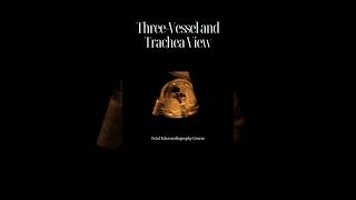 ThreeVessel and Tracheal View [upl. by Asiul]