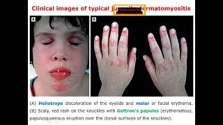 Jevunile Dermatomyositis Rheumatology [upl. by Arikahc]