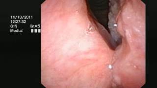 Cancer of the larynx voicebox  wwwdrjeevecom [upl. by Ilamad]