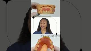 Flexible Partial Dentures for the Front Missing Teeth [upl. by Notsreik635]