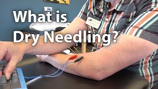 What is Dry Needling [upl. by Lenna]