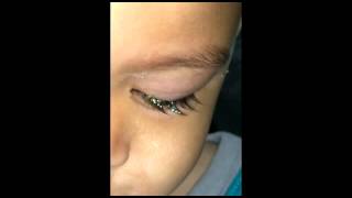 Toddler Pink Eye Conjunctivitis [upl. by Alrzc]