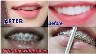 Getting my braces removed before and after  braces  braces off vlog  braces journey in pakistan [upl. by Tteirrah]