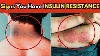 6 Signs You Have INSULIN RESISTANCE in 2024 [upl. by Airetas755]