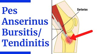 Pes Anserine BursitisTendinitis Evaluation [upl. by Ahtamas]