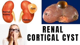 Kidneys Cysts Diagnose and Treatment  Renal Cyst  Kidneys Gathan [upl. by Alaaj]