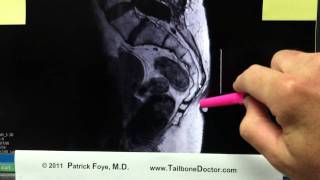 Vitamin E marker for MRI in Tailbone Pain Coccyx Pain [upl. by Nnaerb930]