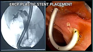 ERCP Plastic stent Placement BDENDOSCOPY [upl. by Gil]