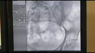 Thrombus aspiration and catheter directed thrombolysis Deepak Heart Institute [upl. by Nnaycart]