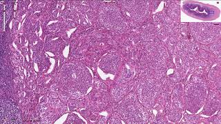 Neuroendocrine Tumor  Appendix  Histopathology [upl. by Krm472]