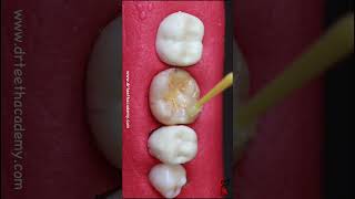 Treating cavities the correct way [upl. by Glennie]