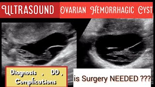 Ovarian Hemorrhagic Cyst Ultrasound  DD  Complications  Prognosis  Role of Surgery [upl. by Dijam]