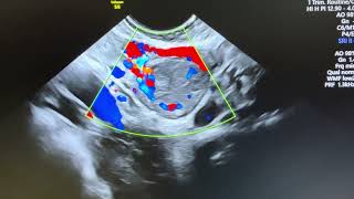 7mm wall thickness of corpus luteum in 5 weeks pregnancy Wall is homogenously smooth [upl. by Nrubyar]