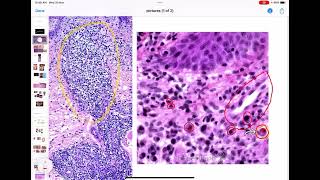 Infection Lecture 2 Syphilis Leprosy Actinomycosis [upl. by Frederico]