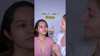 smile lines disappeared smilelines facemassage faceyoga faceexercises facefitness [upl. by Asilef]